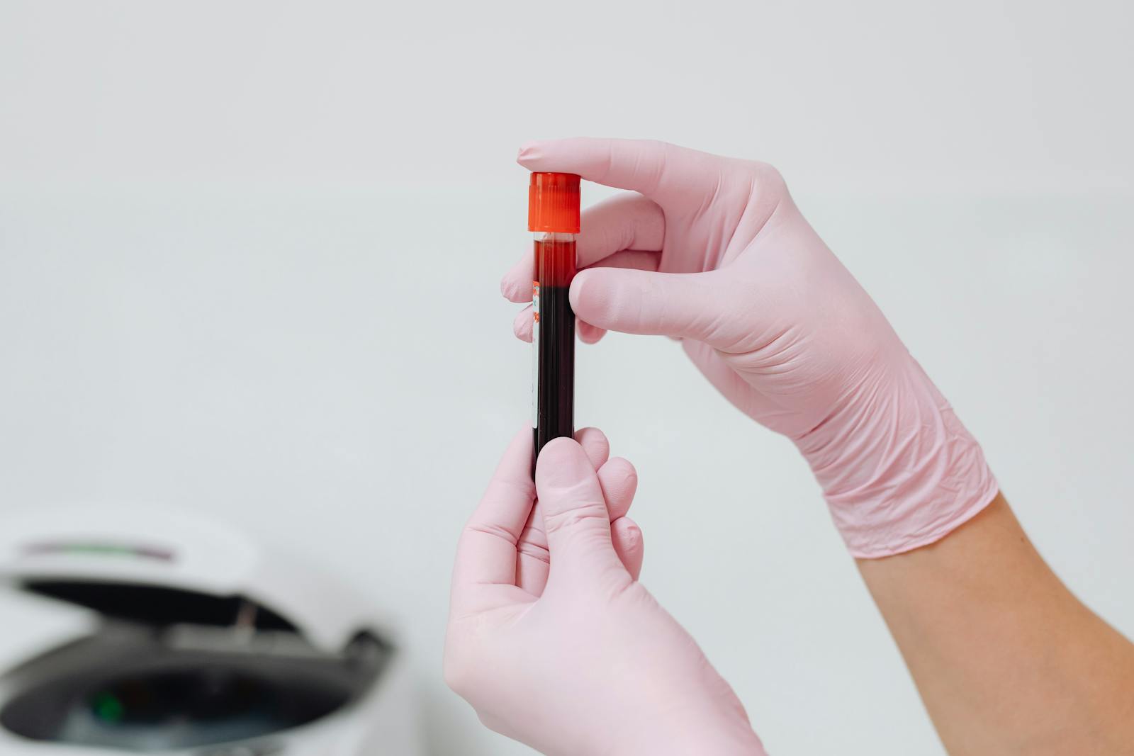 dmnews.com - Rachel Summers - A new Nature Aging study shows blood tests can detect two forms of dementia with up to 96% accuracy in genetically diverse populations most research ignores